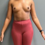 Breast Augmentation Before & After Patient #5444