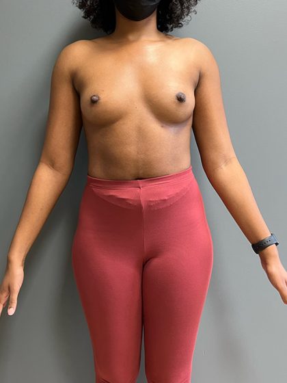 Breast Augmentation Before & After Patient #5444