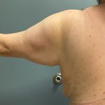 Arm Lift (Scarless Arm Lift) Before & After Patient #5411