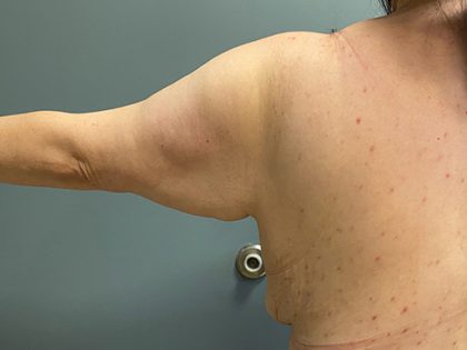 Arm Lift (Scarless Arm Lift) Before & After Patient #5411