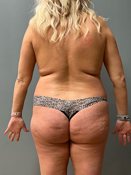 Brazilian Butt Lift Before & After Patient #5428