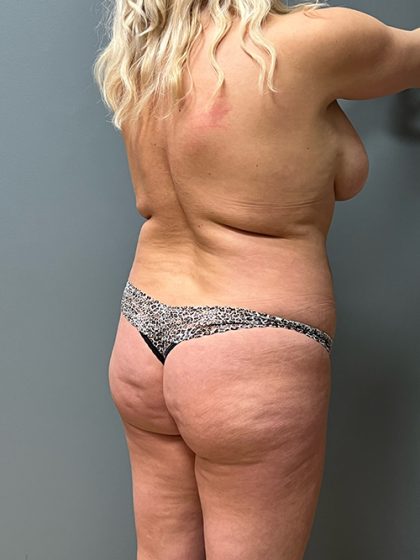 Brazilian Butt Lift Before & After Patient #5428