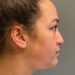 Rhinoplasty Before & After Patient #5556