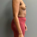 Breast Augmentation Before & After Patient #5444