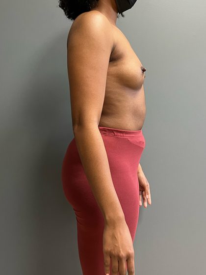 Breast Augmentation Before & After Patient #5444