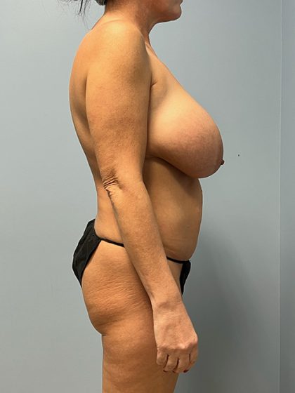 Breast Reduction Before & After Patient #5445