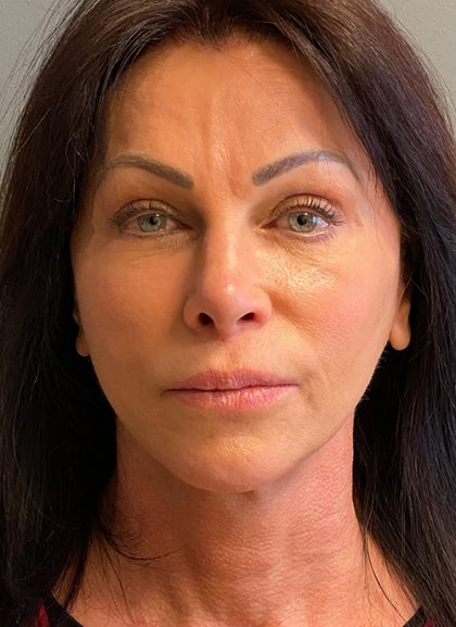 Deep Plane Facelift Before & After Patient #5464