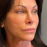 Deep Plane Facelift Before & After Patient #5464