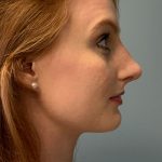 Rhinoplasty Before & After Patient #5557