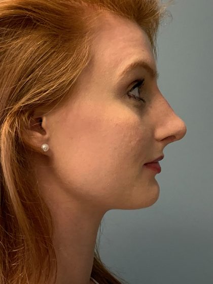 Rhinoplasty Before & After Patient #5557