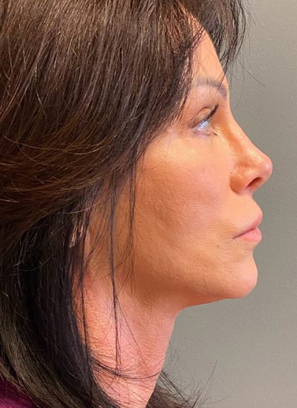 Deep Plane Facelift Before & After Patient #5464