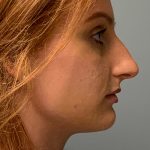 Rhinoplasty Before & After Patient #5557