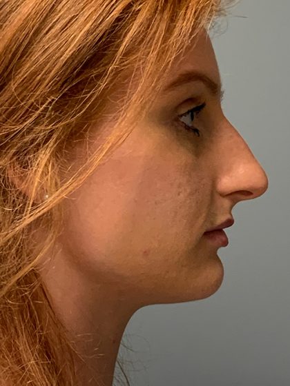 Rhinoplasty Before & After Patient #5557