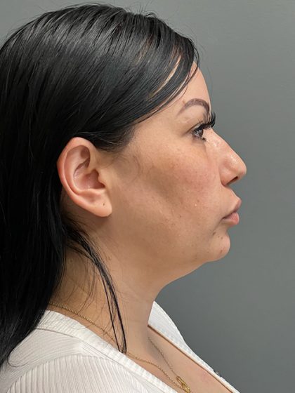 Deep Plane Neck Lift Before & After Patient #5536