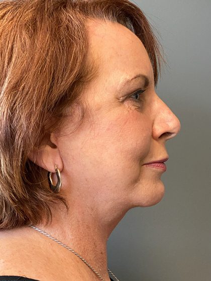 Deep Plane Facelift Before & After Patient #5466