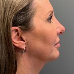 Deep Plane Neck Lift Before & After Patient #5537