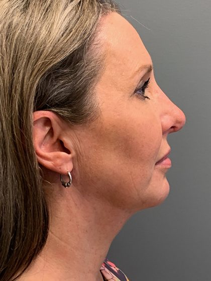 Deep Plane Neck Lift Before & After Patient #5537