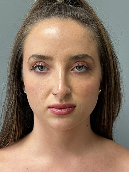 Rhinoplasty Before & After Patient #5558