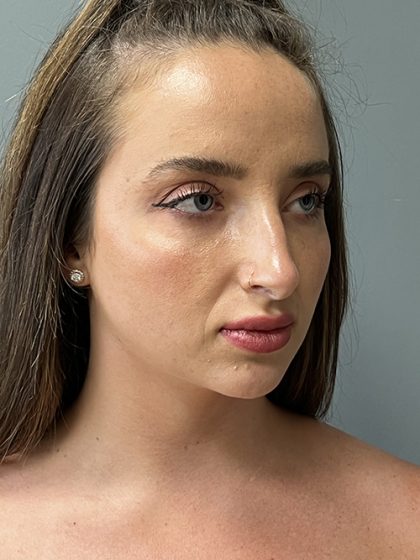 Rhinoplasty Before & After Patient #5558