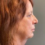 Deep Plane Facelift Before & After Patient #5466