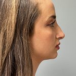 Rhinoplasty Before & After Patient #5558