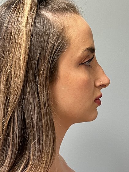 Rhinoplasty Before & After Patient #5558