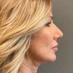 Deep Plane Facelift Before & After Patient #5473