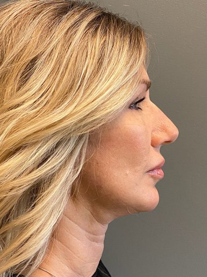 Deep Plane Facelift Before & After Patient #5473