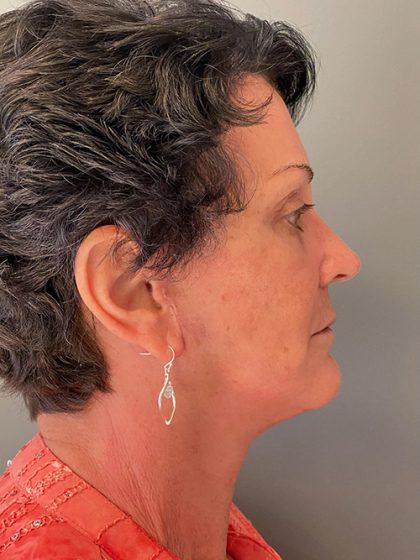 Deep Plane Facelift Before & After Patient #5475