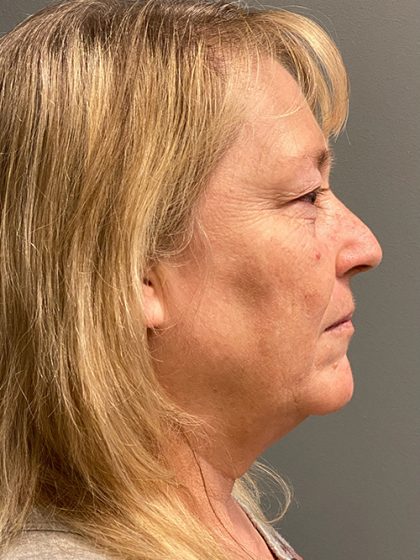 Deep Plane Facelift Before & After Patient #5477