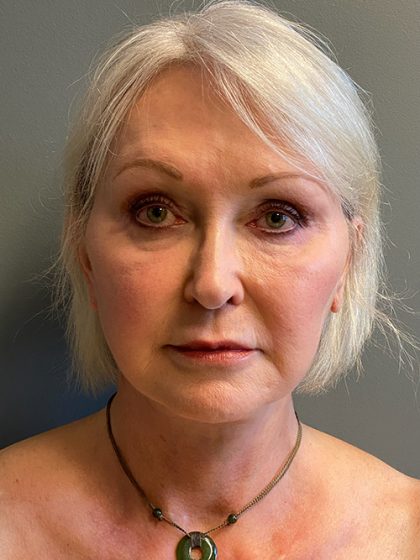 Deep Plane Facelift Before & After Patient #5479