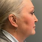 Deep Plane Facelift Before & After Patient #5479