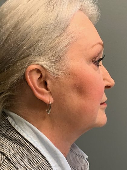 Deep Plane Facelift Before & After Patient #5479