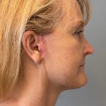 Deep Plane Facelift Before & After Patient #5480