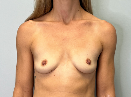 Breast Augmentation Before & After Patient #6013